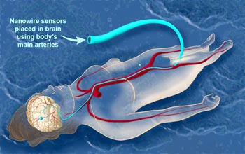 Some day, nanowires routed to the brain through the circulatory system may help patients.