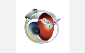 Argus II Retinal Prosthesis System, a brain-machine interface