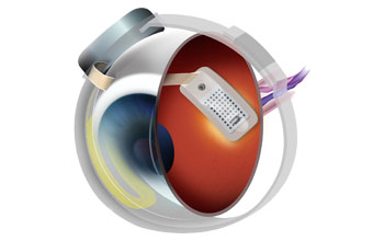 Illustration of an eyeball with retinal implant