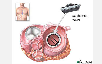 Illustration shows circular mechanical valve inside heart.