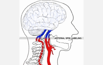 Arterial spin labeling uses an fMRI magnet to "tag" water molecules in the patient's blood