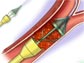 Medical illustration revealing how the SHELTER device traps and removes blood clots in the brain.