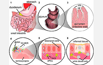 inflamed tissues and white blood cell segment from progression within a patient's intestine