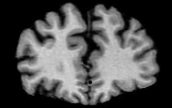 MRI scan of a 79 year-old male human brain.