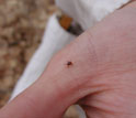 Black-legged ticks shown on a human hand