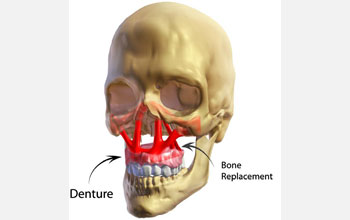 the insertion of a denture into the craniofacial skeleton.