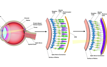 schematic of an eye and implant