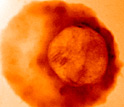 Photo of malaria parasite within a human red blood cell.