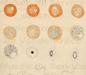 An 1800s sketch of the malaria parasite by the French doctor Alphonse Laveran.