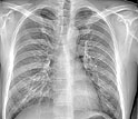 chest xray