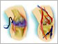 Illustration of ultrasound technology relieving pain and swelling in a knee with osteoarthritis.