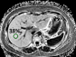 MRI of child's liver with severe NAFLD