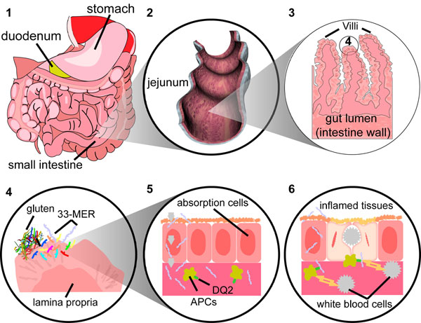 step-by-step progression of celiac sprue within a patient's intestine; caption is below
