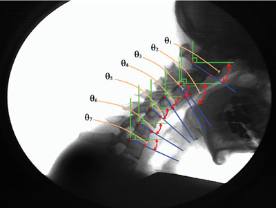 X-ray of the neck flexed downward