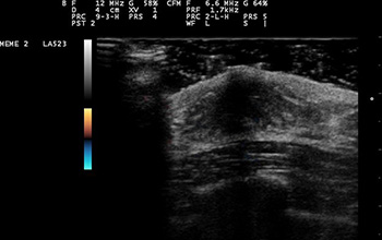 ultrasound image of breast tissue