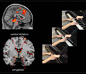 Functional Magnetic Resonance Imaging scans of aggressive boys showing strong reaction in brain.