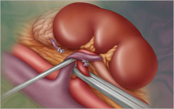 A depiction of the kidney as seen in a live donor transplant.