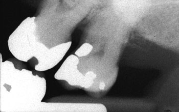 X-ray image of teeth at one angle
