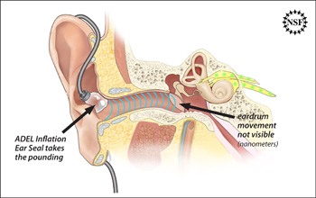 Illustration of the ADEL(TM), which looks like a tiny ear-sealing balloon.