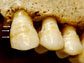 teeth were examined for linear enamel hypoplasia