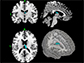 brain region of anterior thalamic radiation