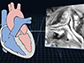 heart valve with RF coil