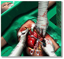 3D graphical reconstruction of surgery, caption is below